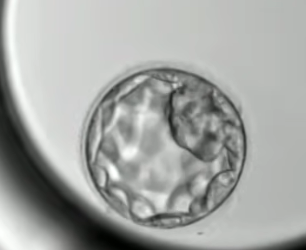 Embriyolarda PGT yöntemi bebek sahibi olmayı hızlandırıyor