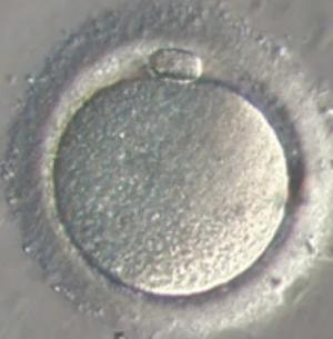 Oosit (Yumurta) Dondurma Nedir, Kimlere ve Nasıl Uygulanır?