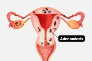 Endometriozis, Adenomyozis ve Tüp Bebek Tedavisinde Yumurta (Oosit) Kalitesi Üzerine Etkileri