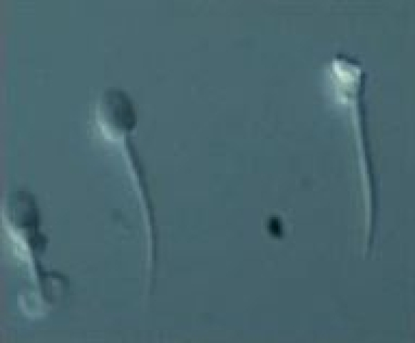 Sperm Morfolojisi: Şiddetli Sperm Morfolojik Defektleri